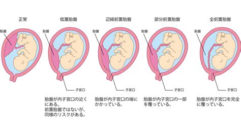 胎盤前置|前置胎盤について